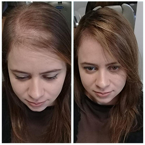 Folixil Antes e Depois, Depoimentos, Onde Comprar